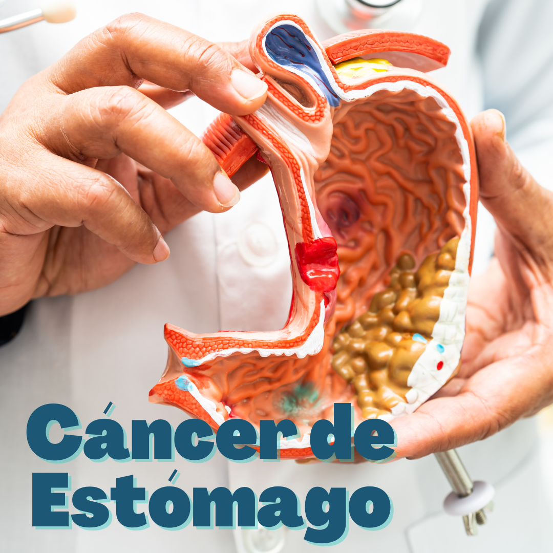 Cáncer de Estómago